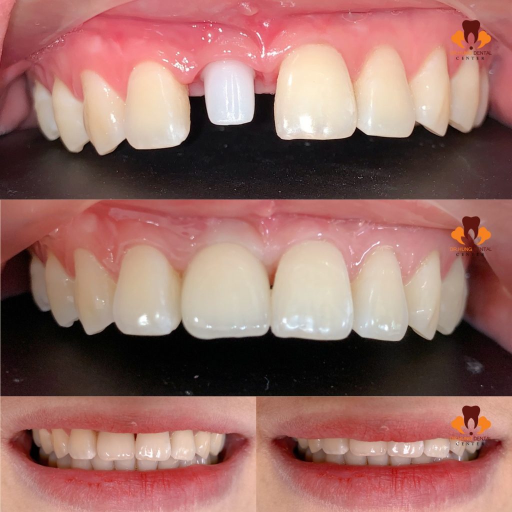 cấy ghép implant tại gia lâm