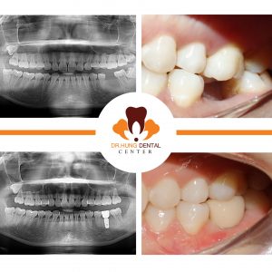 cấy ghép implant tại gia lâm