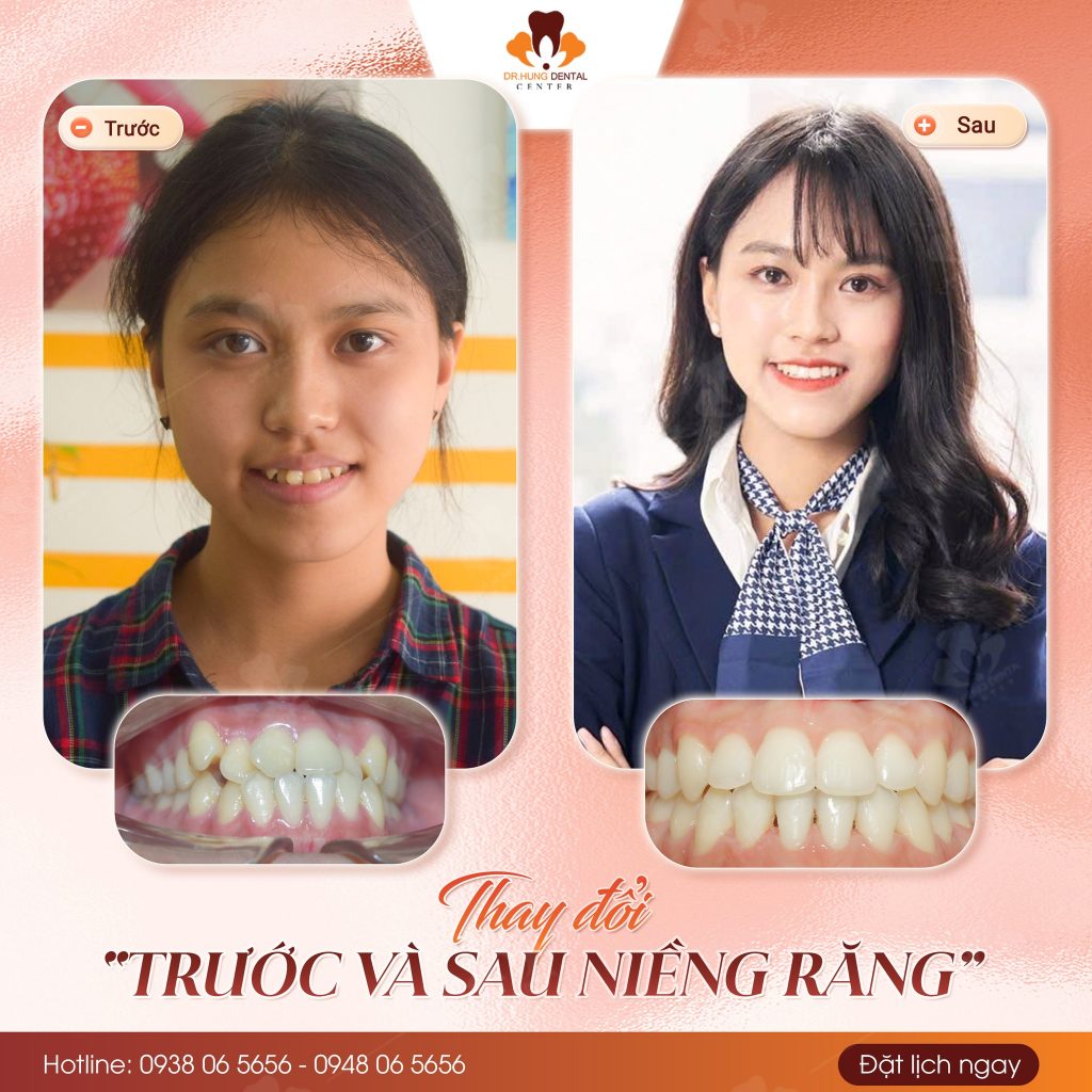 Niềng răng tại Gia lâm