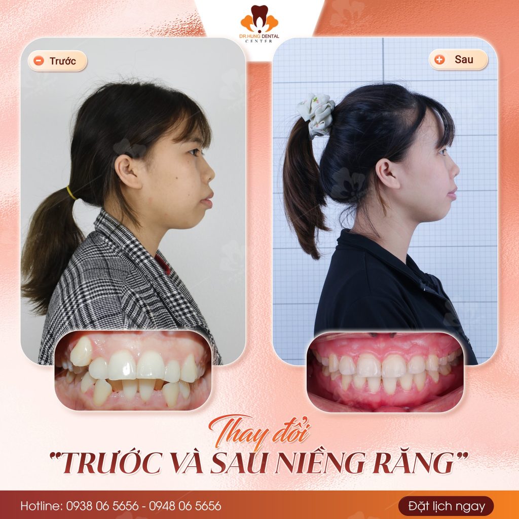 Niềng răng tại Gia lâm