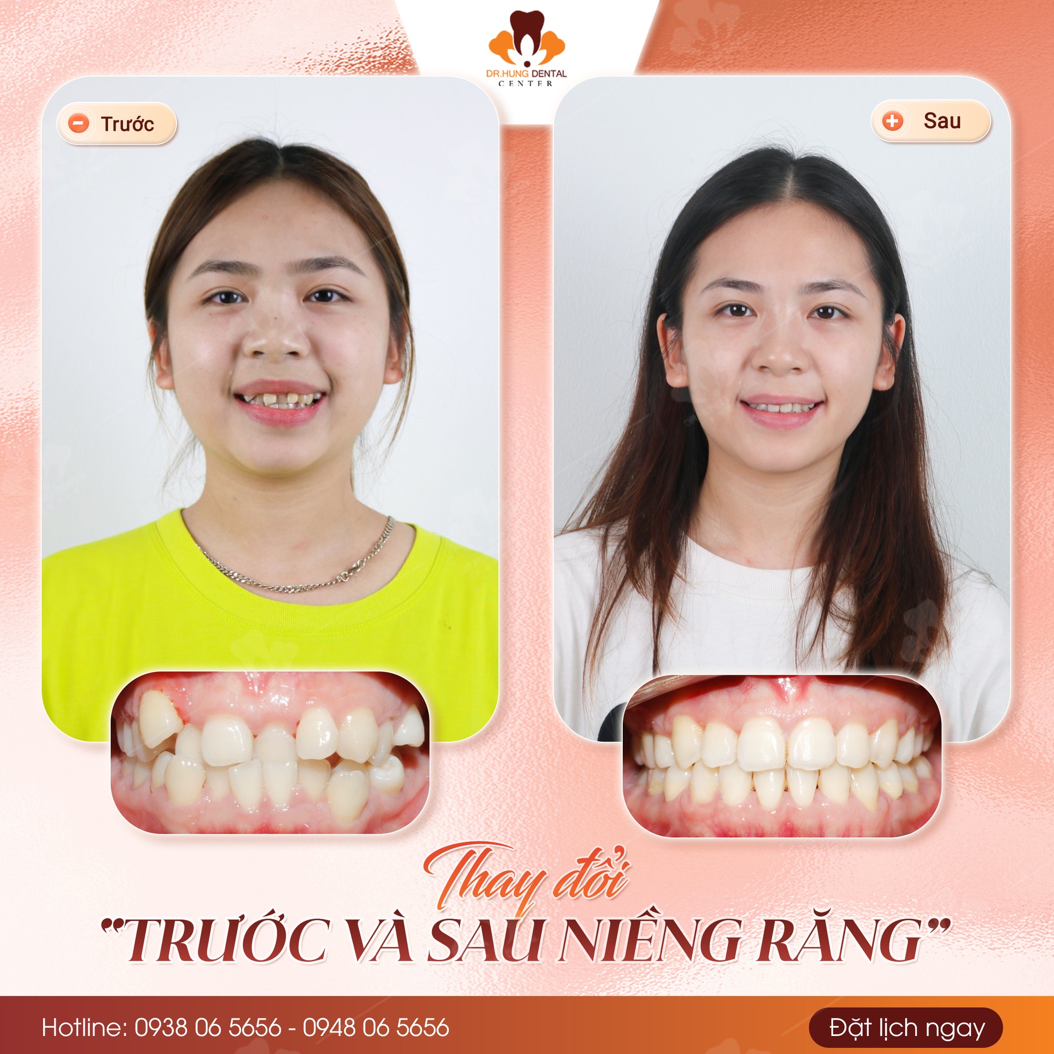 Niềng răng tại Gia lâm