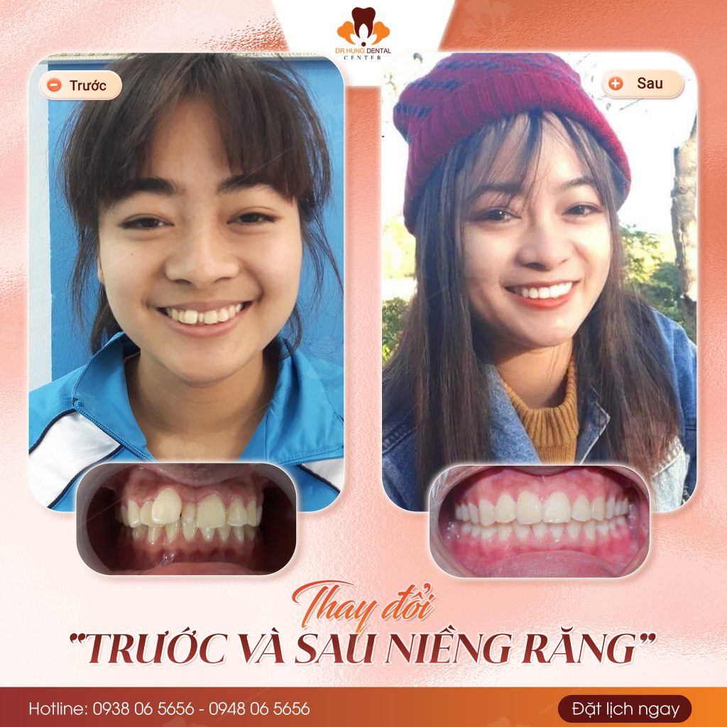Niềng răng tại Gia lâm