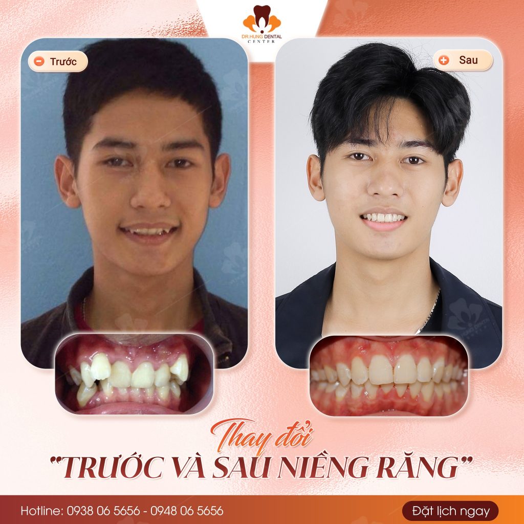 Niềng răng tại Gia lâm