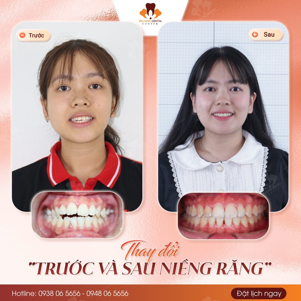 Niềng răng tại Gia lâm