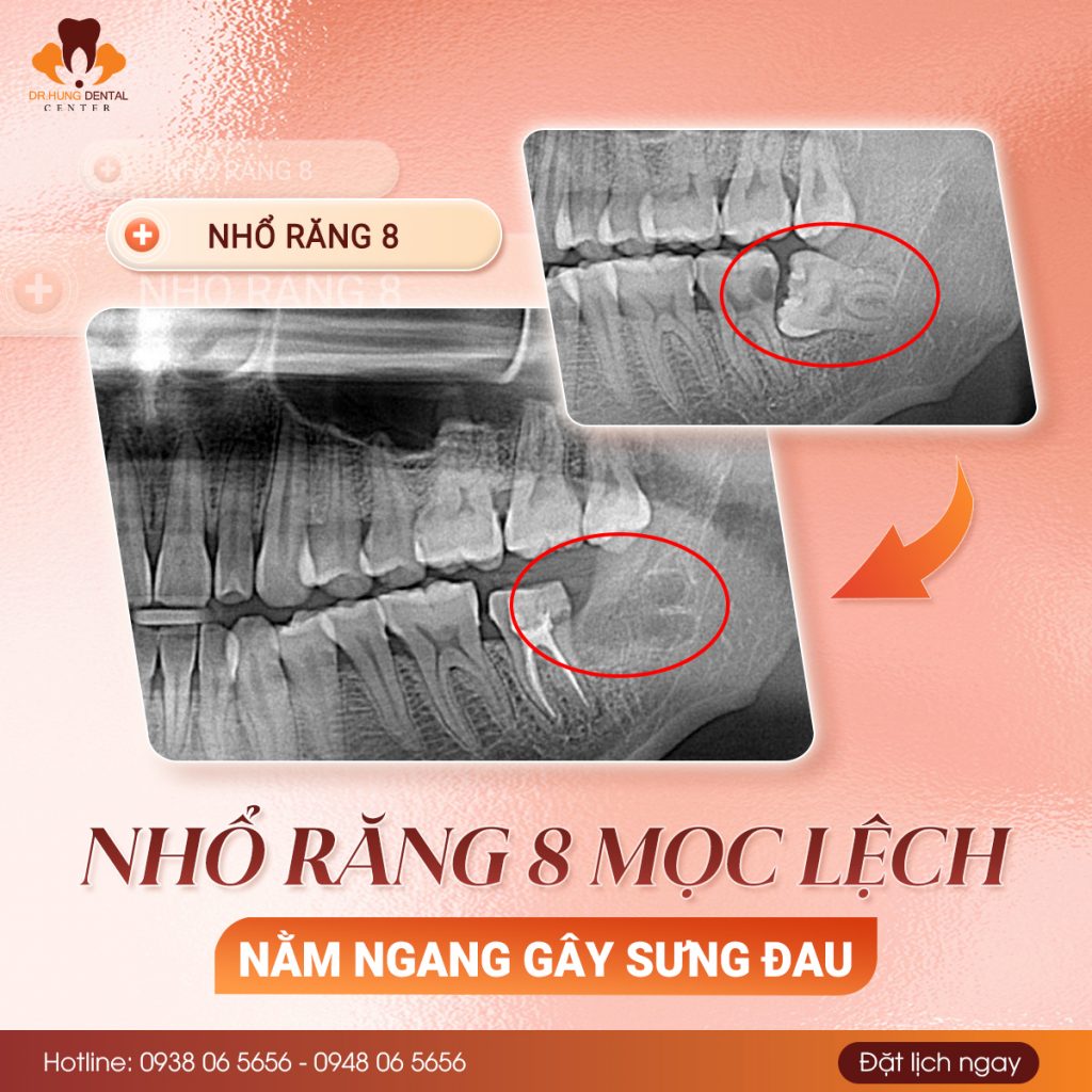 Nhổ răng khôn tại gia lâm