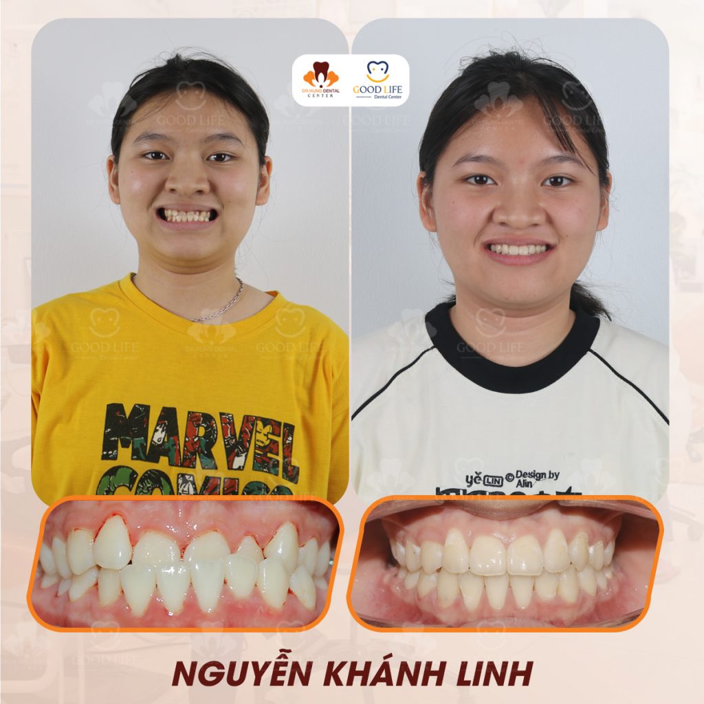 niềng răng trẻ em tại Gia Lâm