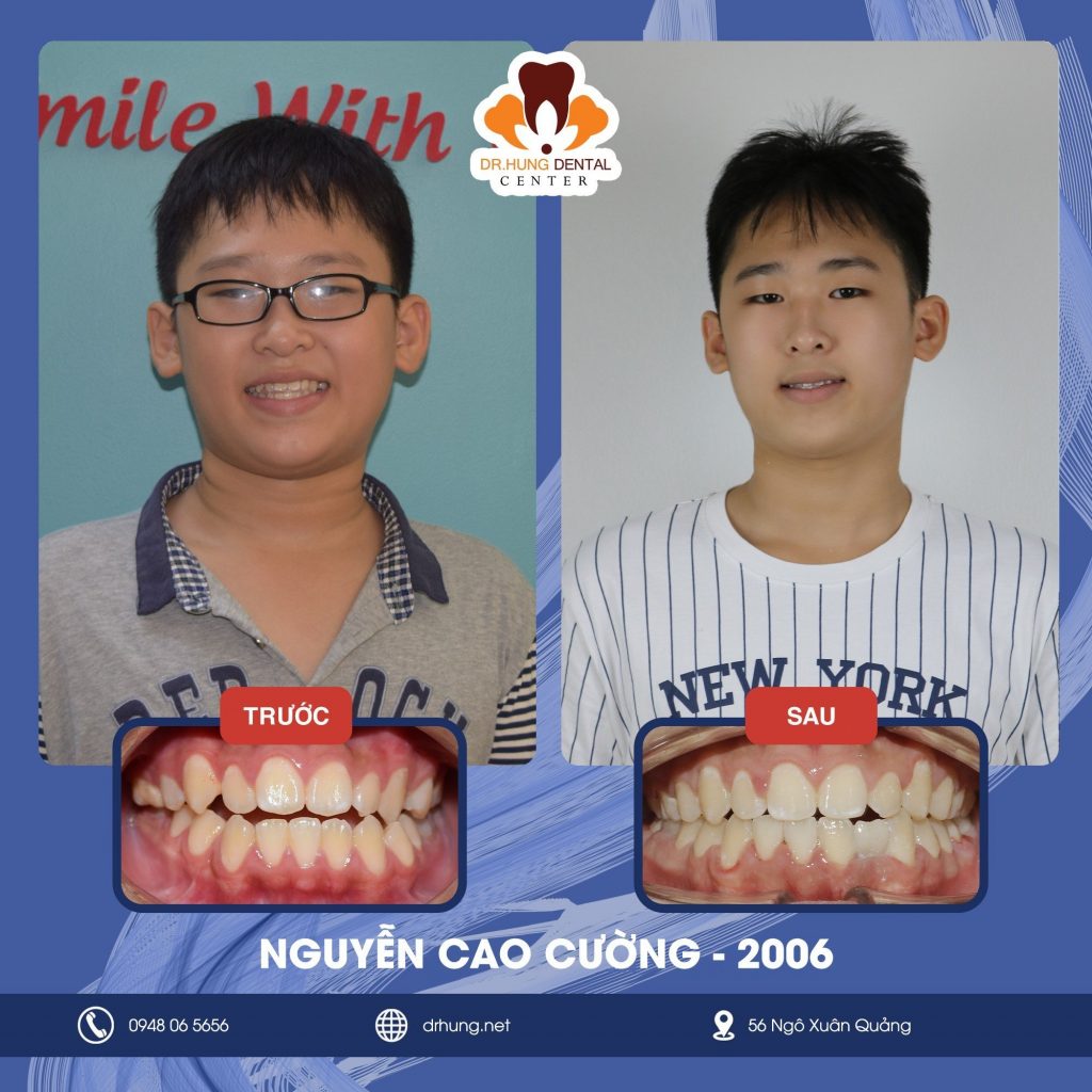 niềng răng trẻ em tại Gia Lâm