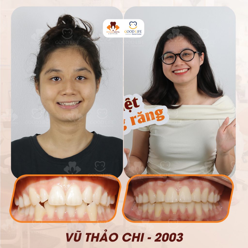 niềng răng uy tín