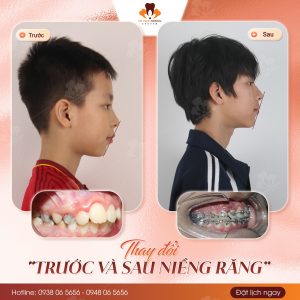 niềng răng trẻ em tại Gia Lâm