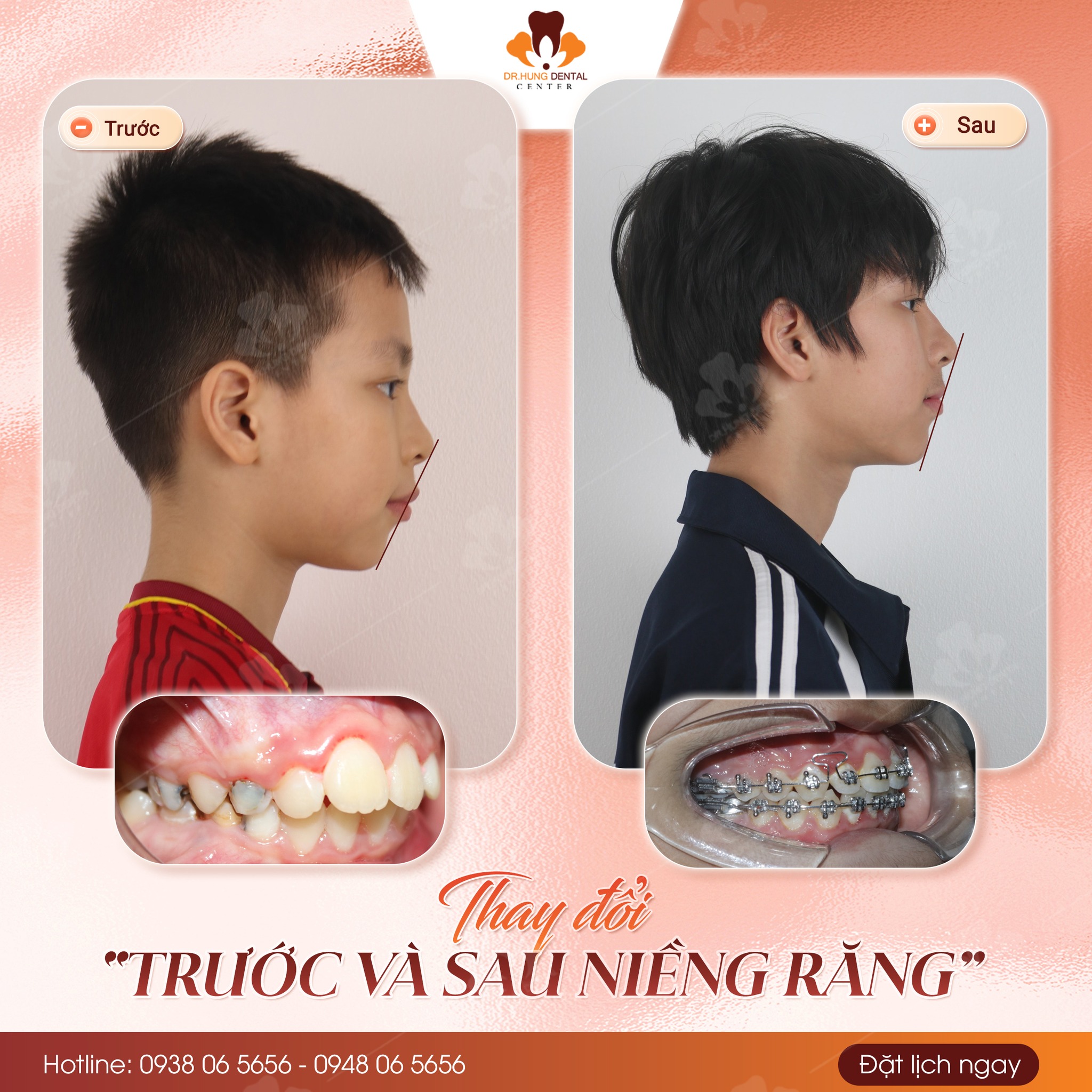 niềng răng trẻ em tại Gia Lâm