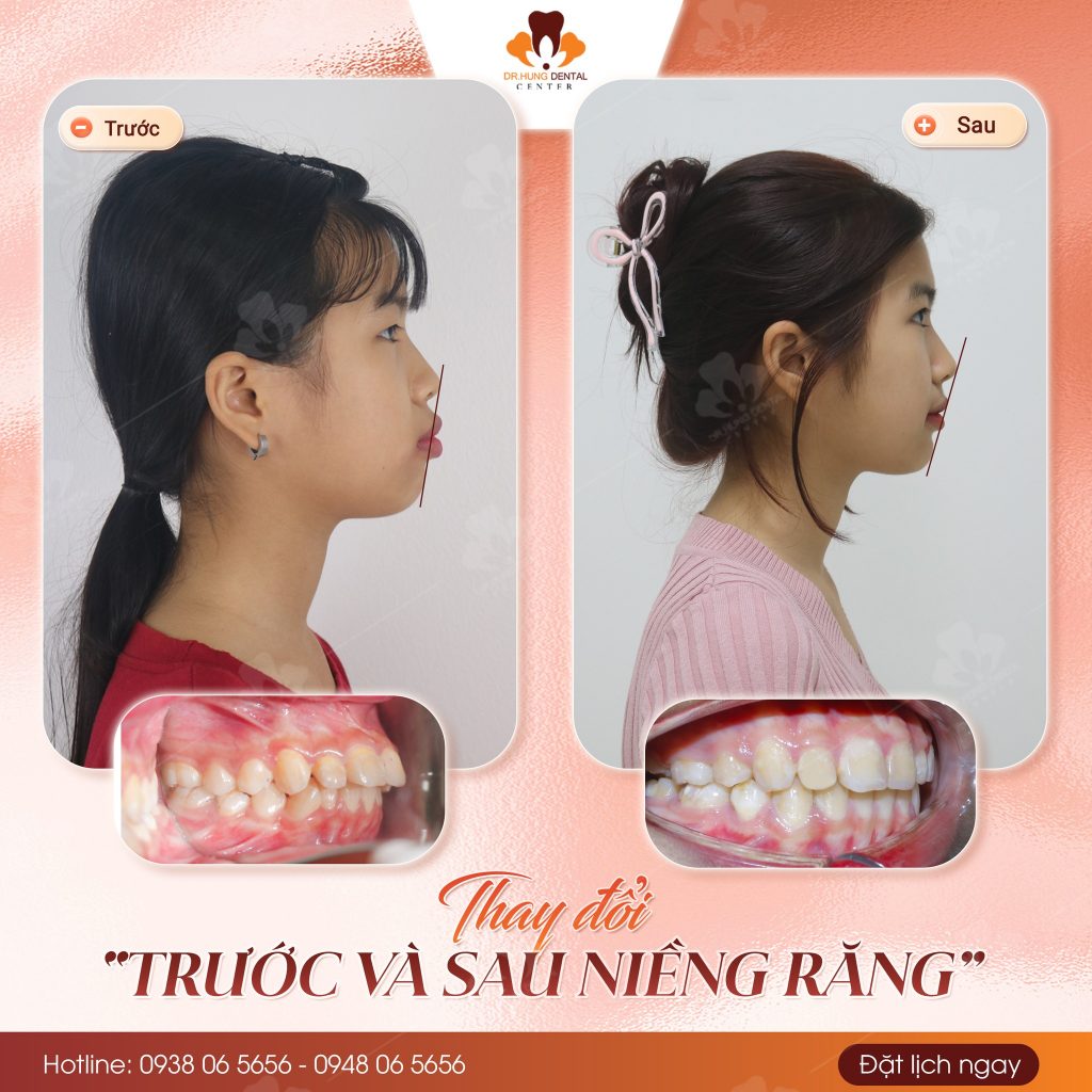niềng răng trẻ em tại Gia Lâm