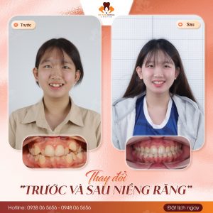 niềng răng uy tín