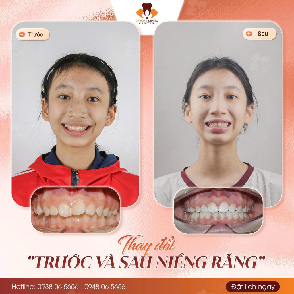 niềng răng trẻ em tại Gia Lâm