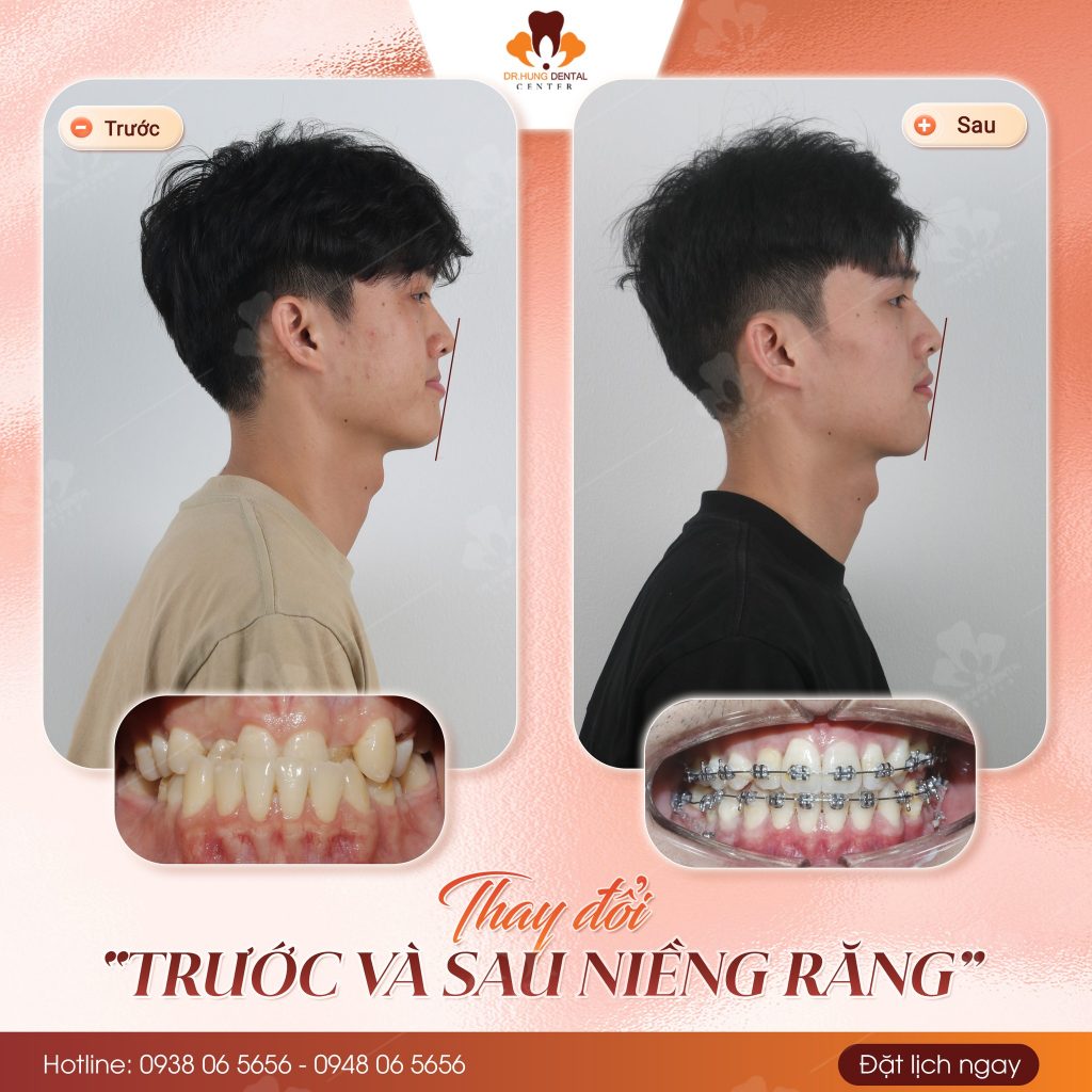 niềng răng uy tín