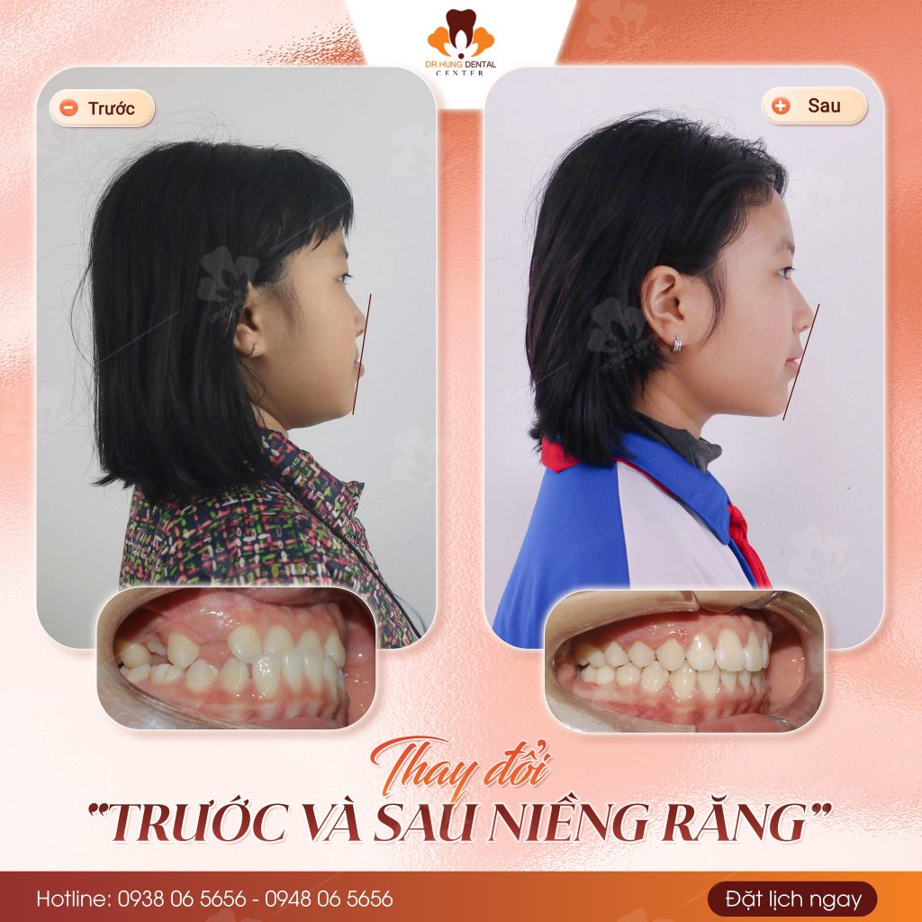 Niềng răng cho con