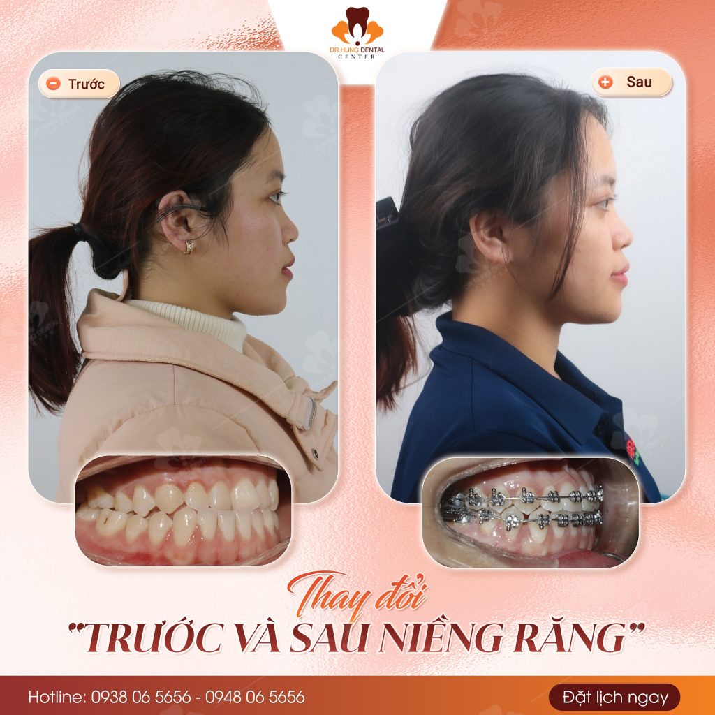 niềng răng sinh viên