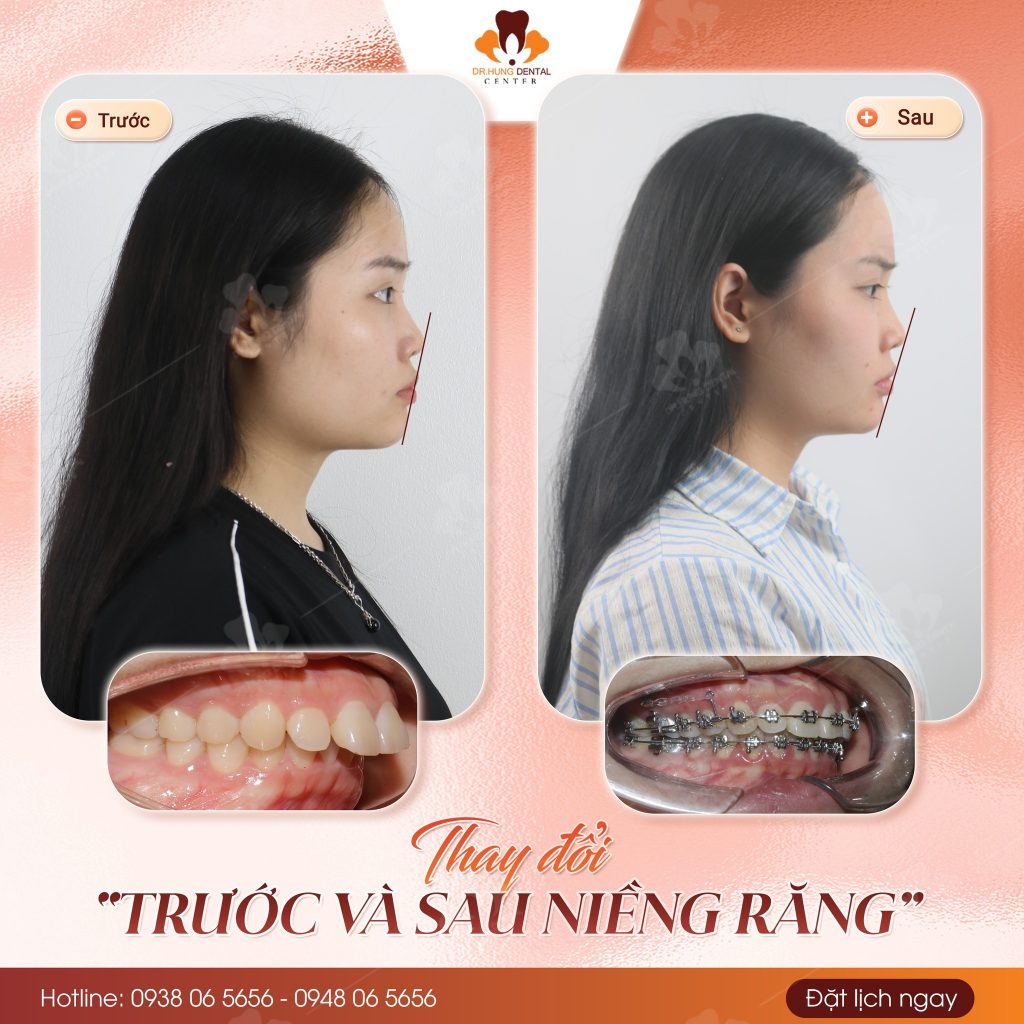 niềng răng sinh viên