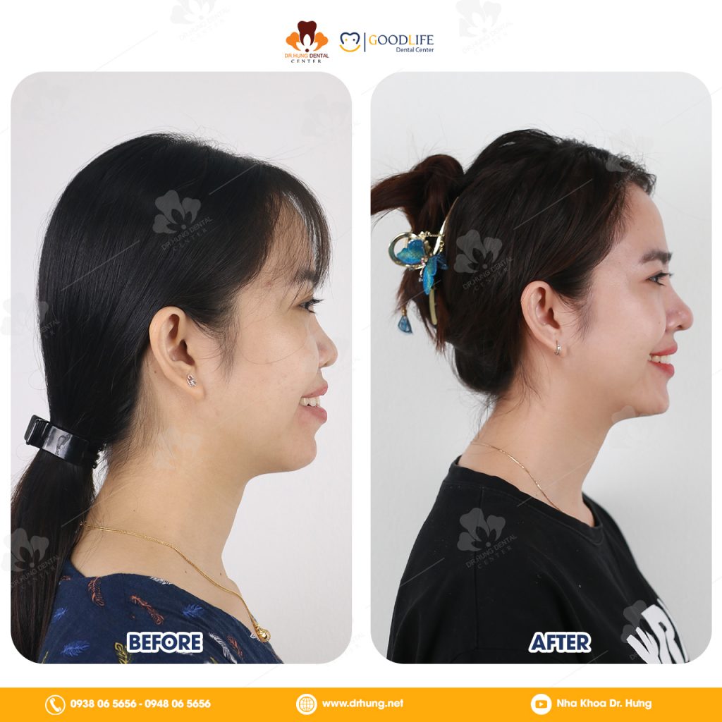 niềng răng sinh viên