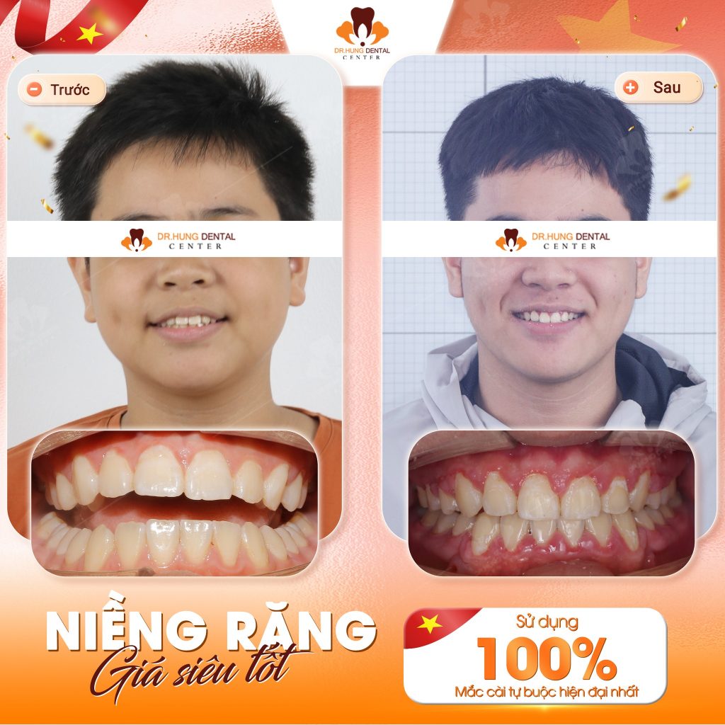 Niềng răng cho con