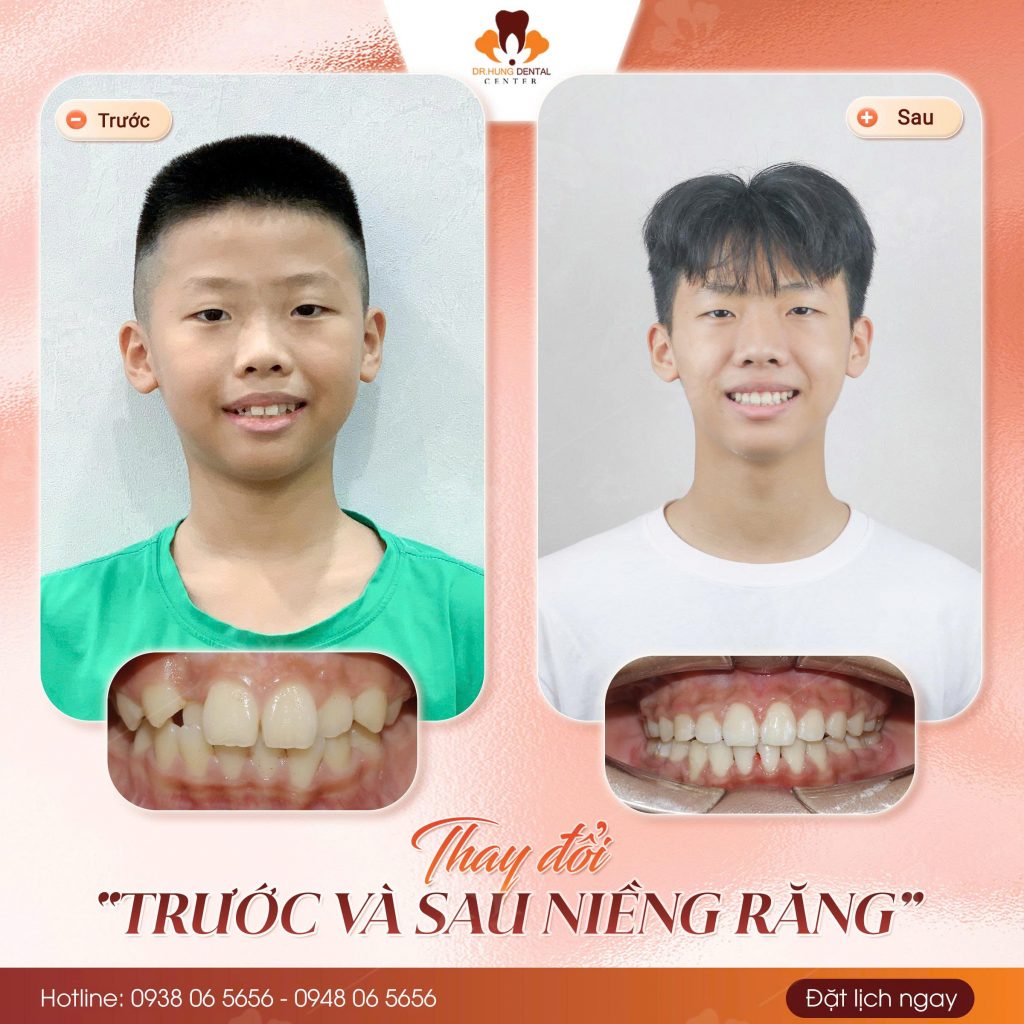 niềng răng trẻ em tại Gia Lâm