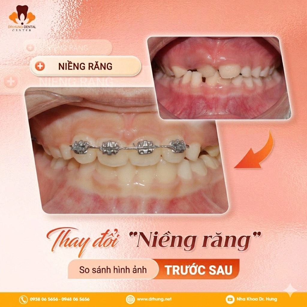 niềng răng cho trẻ