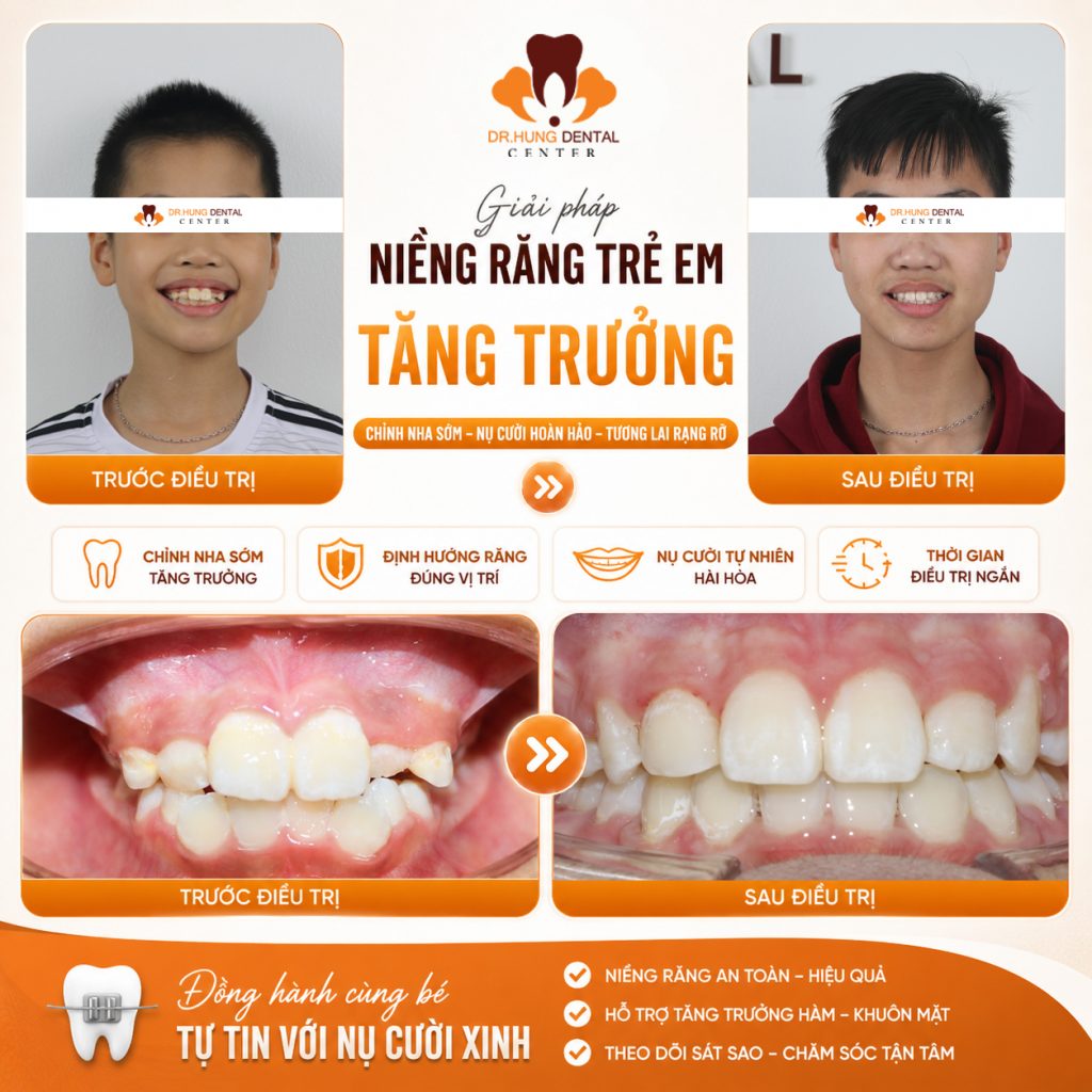 Niềng răng cho trẻ