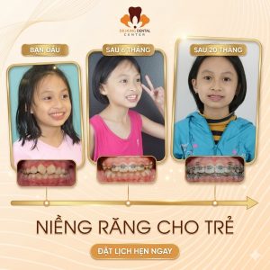 niềng răng cho trẻ