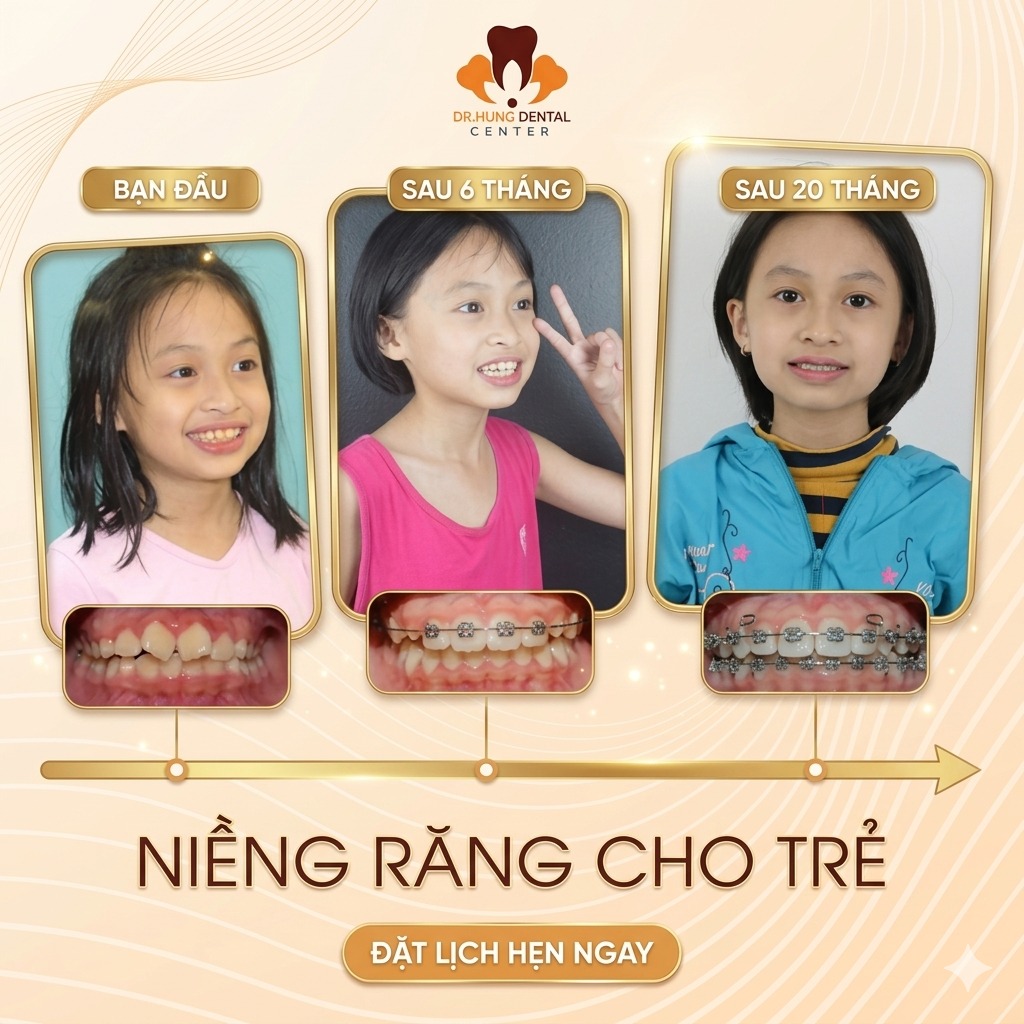 niềng răng cho trẻ