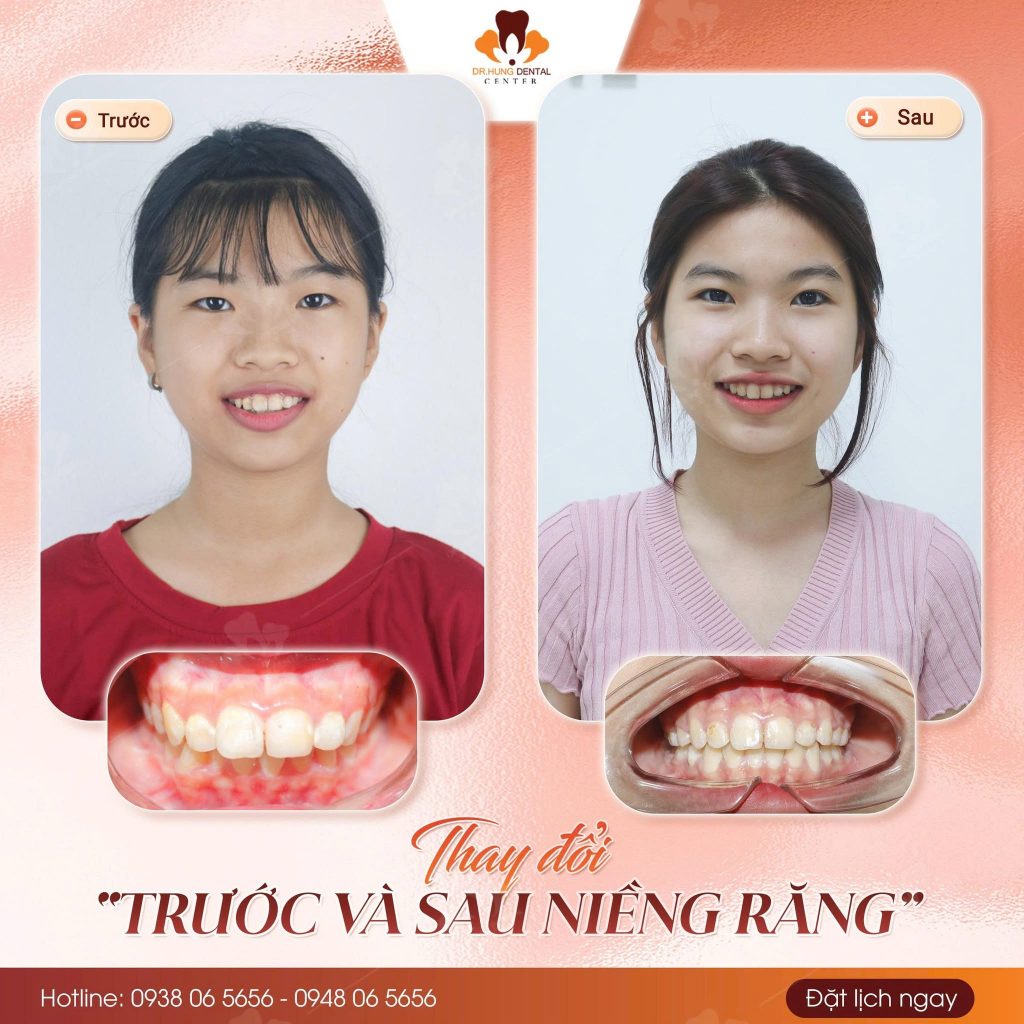 bé hô nhẹ có cần niềng không