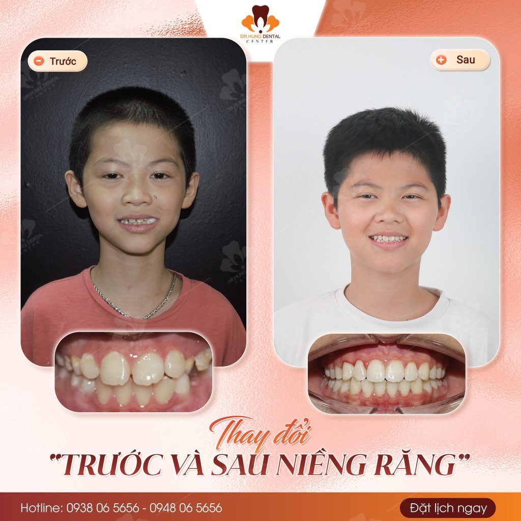 Niềng răng cho trẻ tại gia lâm