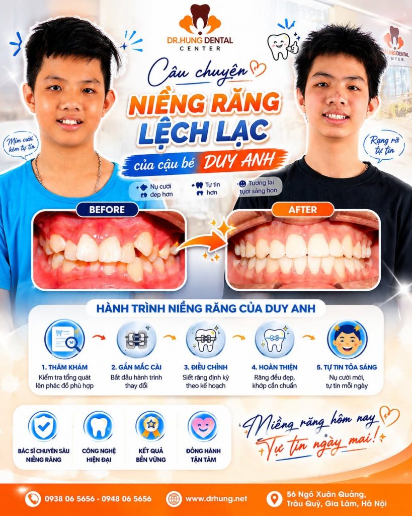 niềng răng trẻ em tại gia lâm