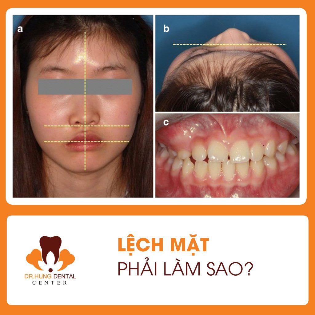 mặt lệch