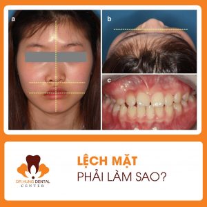 mặt lệch
