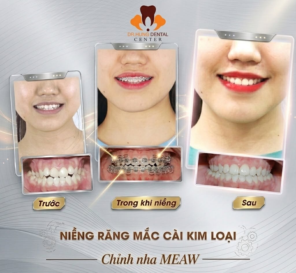 niềng răng MEAW GEAW