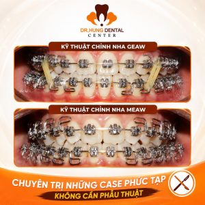 niềng răng MEAW GEAW