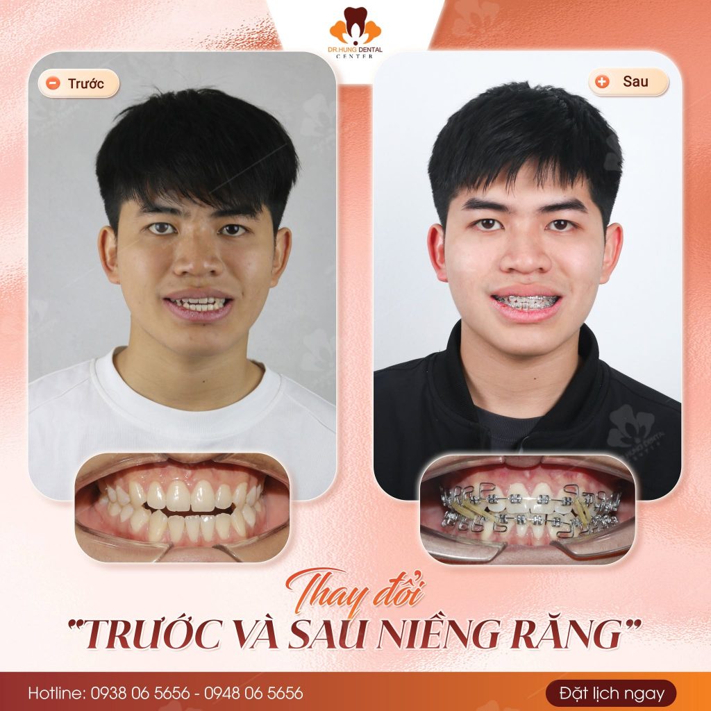 Lệch mặt
