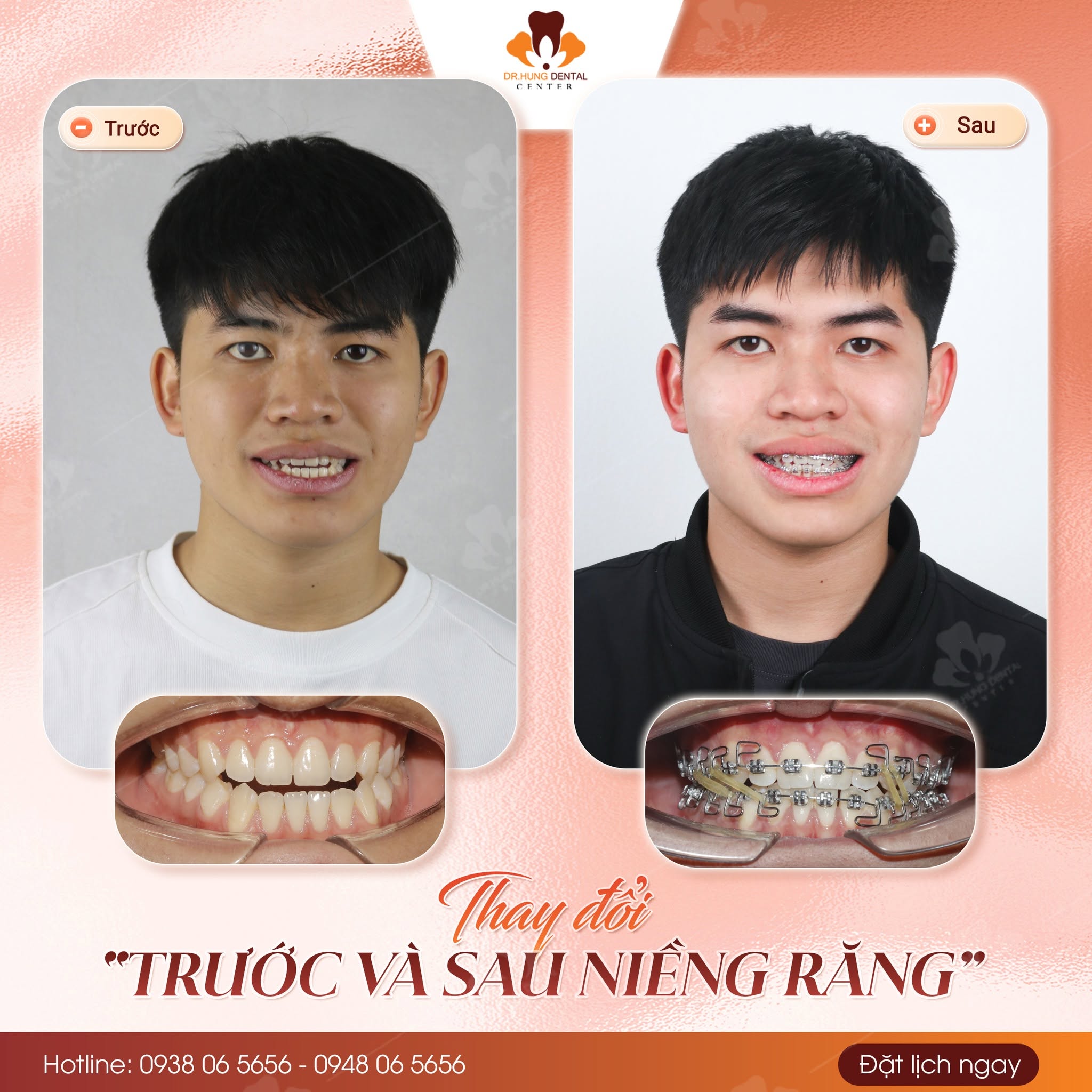 Lệch mặt