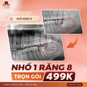Nhổ răng khôn