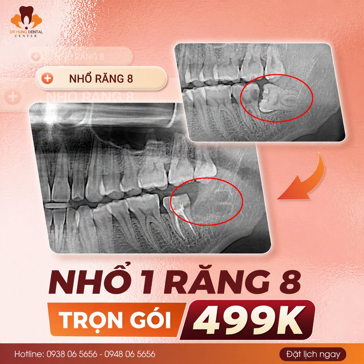 Nhổ răng khôn