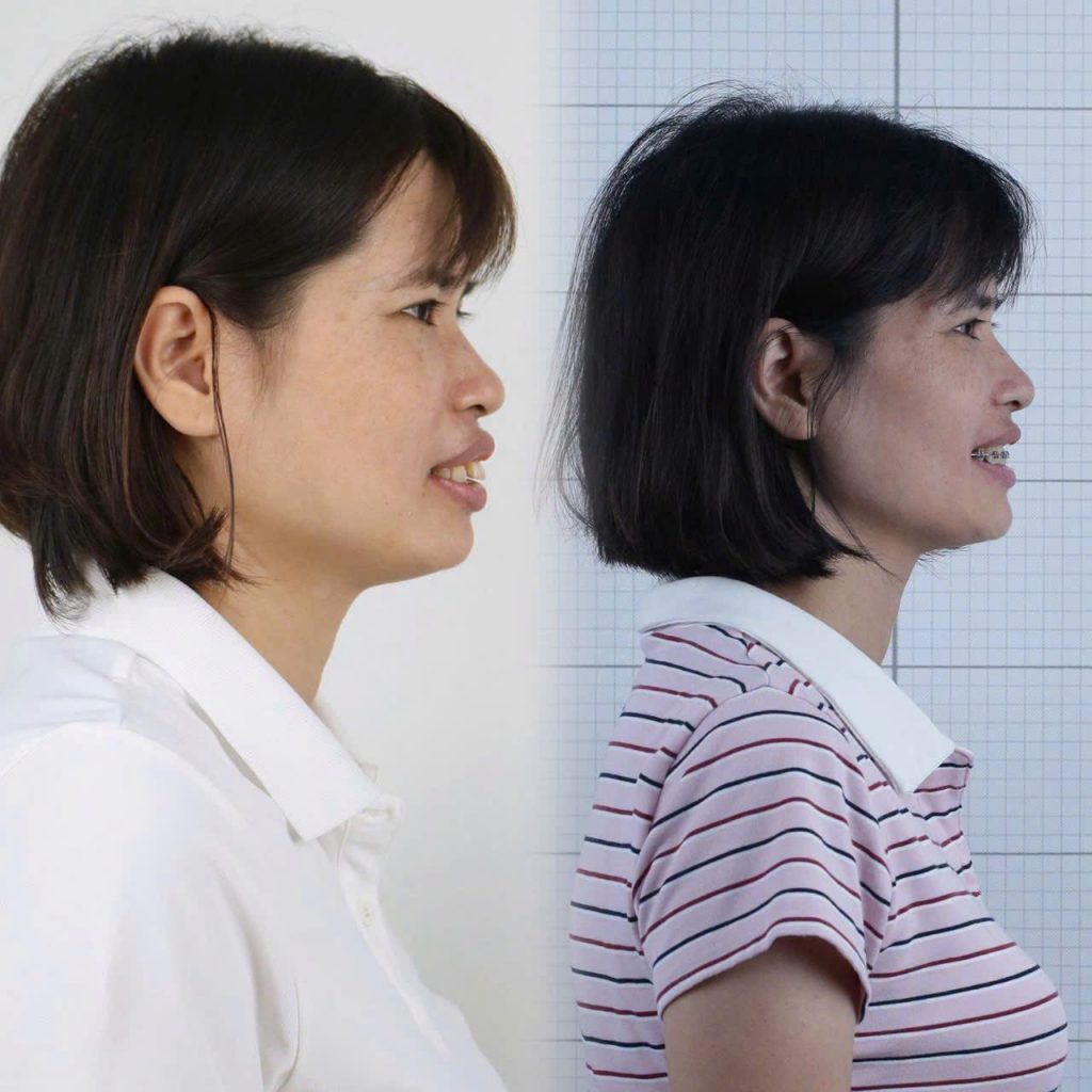 Niềng răng tuổi 35