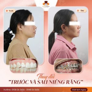 Niềng răng tuổi 35
